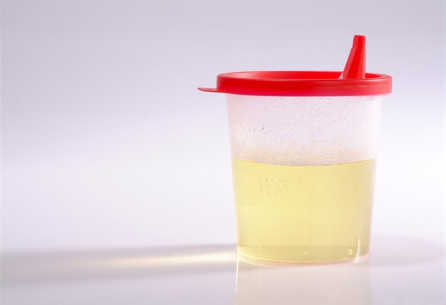 Šest netypických odstínů moči, které mohou upozornit na zdravotní potíže