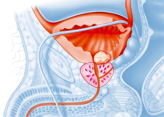 Rakovina prostaty nebolí. Jak poznat varovné příznaky?